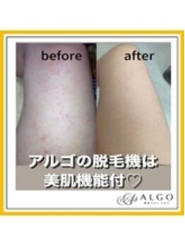 アルゴ 太田店(ALGO)/ 脱毛しながら美肌へ！！