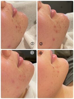 ハーシークレット(Her secret)/ハーブピーリングDT有・経過