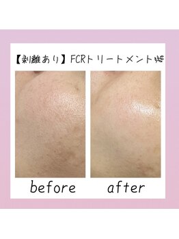 シャルム ココ 八尾店(Charme coco)/毛穴・シミケア　１回目