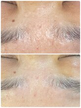 ニコリ(Nicori)/ハーブピーリング