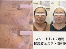 施術のあとにホームケアのアドバイスをさせていただいております