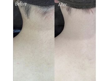 ハイリー(Hily)/うなじ・背中 before、after