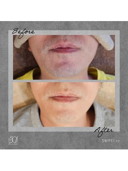 ゴーマルイチ(501)/メンズ脱毛 Before/After