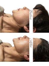 マヌレニ(manuleni)/首の縦じわは加齢のサイン