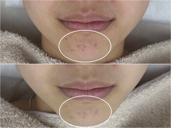 アンリミット 原宿竹下通り店(Une limit)/【本気の肌質改善】