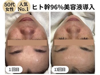 ディレイア ザ コスメ 有楽町マルイ店(direia the cosme)/月1～2回/くすみ［有楽町］