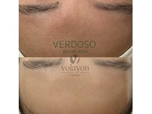 ベルーナビューティ 西新宿(Beluna beauty)の雰囲気（韓国定番の毛穴管理【水光アクアピール】で詰まり・黒ずみ改善）