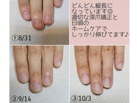 深爪矯正
