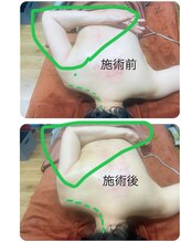 ひまわり 久屋店/深部筋膜リリース