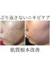 人気NO２【本気のニキビケア】肌荒れ特化REVIハーブピーリング18700→11000