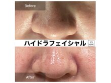 ビテキサロン ソワメーム(biteki salon SOI-MEME)の雰囲気（毛穴の奥まで美容液と吸引の力によって綺麗に洗い流します◎）