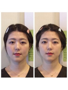 健幸堂 本店/小顔矯正1回