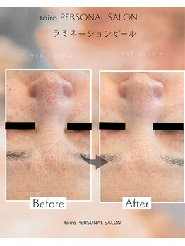 トイロ(toiro)/ラミネーションピール＋炭酸P