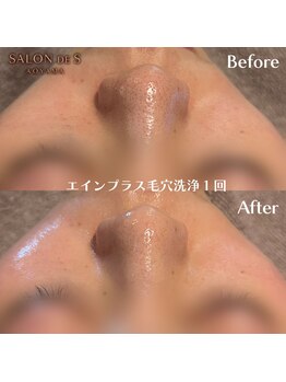 サロン ド エス アオヤマ(SALON DE S AOYAMA)/エインプラス毛穴洗浄