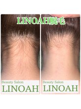 ビューティーサロン リノア(LINOAH)/◎結果重視◎【うなじ脱毛】