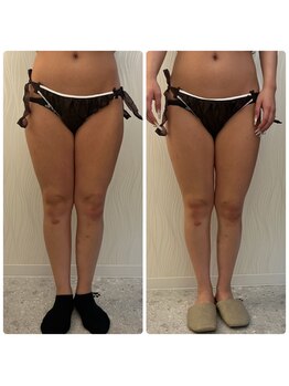 ソルニス(Solnis.)/痩身☆脂肪分解/ハイパーナイフ