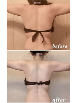 アンフィニ(infini)/短期集中コース全身5回(2ヶ月)