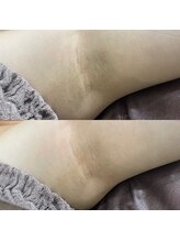 ウルル(ULuLu)/ワキの黒ずみにカーボキシー！