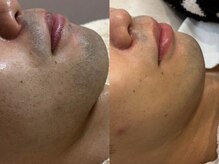 エミュ(emu)/メンズ脱毛も大人気！