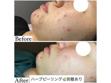 マドモアゼル 麻布十番/ハーブピーリング