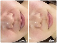 ボヌールデソワ(Bonheur de Soi)/ハーブピーリング　美白/毛穴