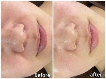 ボヌールデソワ(Bonheur de Soi)/ハーブピーリング 美白/毛穴