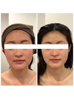 小顔になりたい