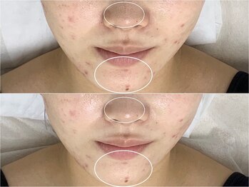 アンリミット 原宿竹下通り店(Une limit)/【顎の手強いニキビ】