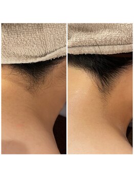 アルカディア(Arcadia)/うなじ脱毛☆