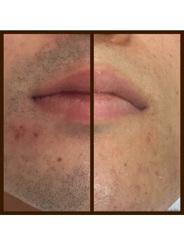 リアンジュ/ヒゲ脱毛の経過