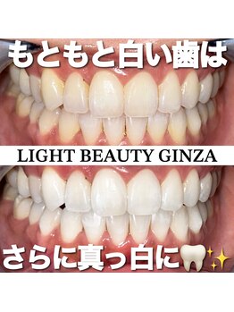ライトビューティー 銀座店(LightBeauty)/東銀座/ホワイトニング/症例写真
