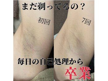 ウィズティ(with.T)/効果が早い!ワキ脱毛