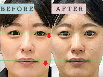 エルシンメトリー矯正院(ailesシンメトリー矯正院)/before＆after　ailes式小顔矯正