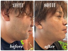 men'sヒゲ脱毛。１回30分×８回で驚きの効果。お試し3800円