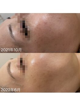 ラ クレール ビューティーサロン(LA CLAIR)/【症例】色ムラ・美白