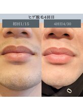 エピ リブレ(8epi.Libre)/ヒゲ脱毛♪圧倒的抜け感を約束　