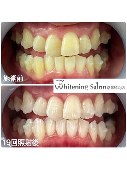 ホワイトニングサロン 京都烏丸店/ホワイトニング施術例