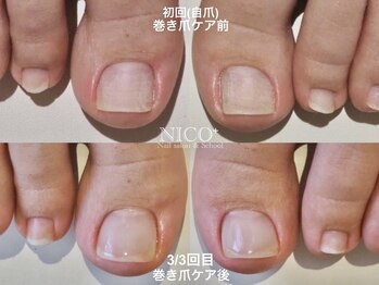 ニコプラス(NICO+)/巻き爪ケア