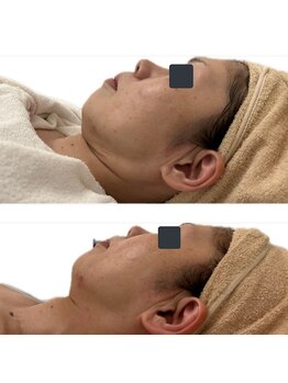 カレン(KAREN)/小顔リフトD×脂肪燃焼