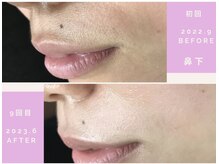 モアトゥインクル 山口店(MORE twinkle)/★症例写真★