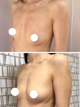 ラディス(Radice.)/30代産後ママでもバストアップ！