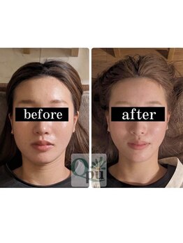 キュープ 松戸店(Qpu)/小顔頭蓋骨矯正