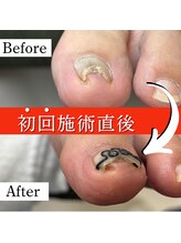 巻き爪矯正センター 沖縄 宜野湾/巻き爪矯正　ビフォーアフター