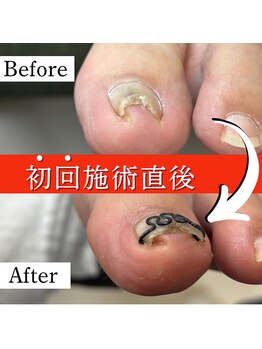 巻き爪矯正センター 沖縄 宜野湾/巻き爪矯正　ビフォーアフター