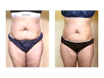 ビユー エスティカ オリエンタル 伊勢崎店(BIYU ESTETICA ORIENTAL)/リンパドレナージュ