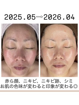 サロン ド マーシャ(salon de Marsha)/シミ!赤ら顔!毛穴!気になる!