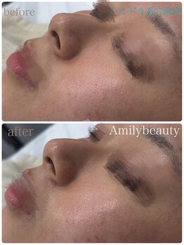 アミリービューティー ひたち野うしく店(Amily beauty)/ハイドラ毛穴洗浄