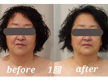 コリ チル(Kori Chill)/【ハイパーフェイシャル】