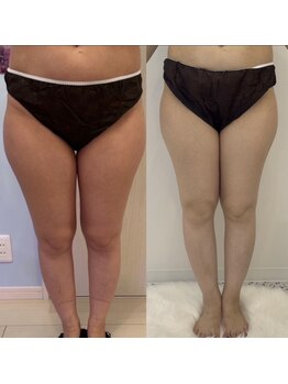 メゾン アンジュ(Maison Ange)/【ダイエットコース3回目】