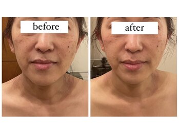 アンリール(ANRIRE)/ゼロジーフリー1回の施術